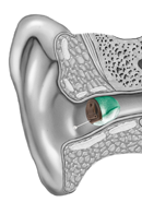 INVISIBLE IN THE CANAL (IIC) Hearing Aid
